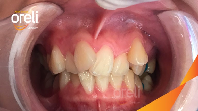 Ca niềng chỉnh chen chúc hẹp hàm nặng cả trên và dưới – Kết quả điều trị thực tế tại nha khoa Oreli