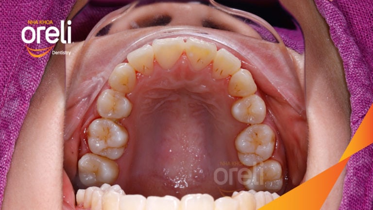 Ca niềng chỉnh chen chúc hẹp hàm nặng cả trên và dưới – Kết quả điều trị thực tế tại nha khoa Oreli
