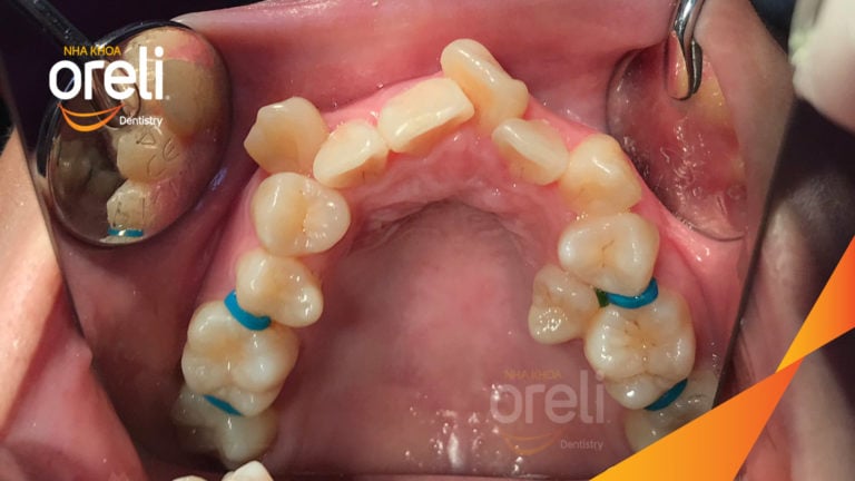 Ca niềng chỉnh chen chúc hẹp hàm nặng cả trên và dưới – Kết quả điều trị thực tế tại nha khoa Oreli