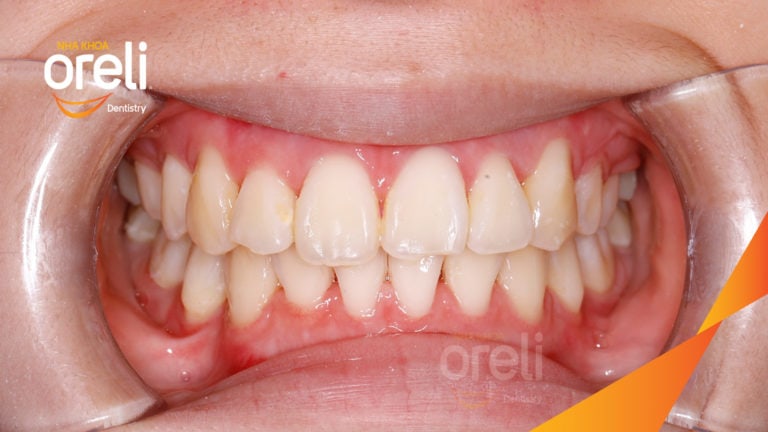 Ca niềng chỉnh chen chúc hẹp hàm nặng cả trên và dưới – Kết quả điều trị thực tế tại nha khoa Oreli