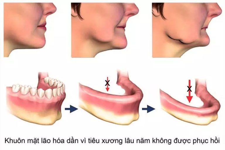 tiêu xương hàm trên có nguy hiểm không
