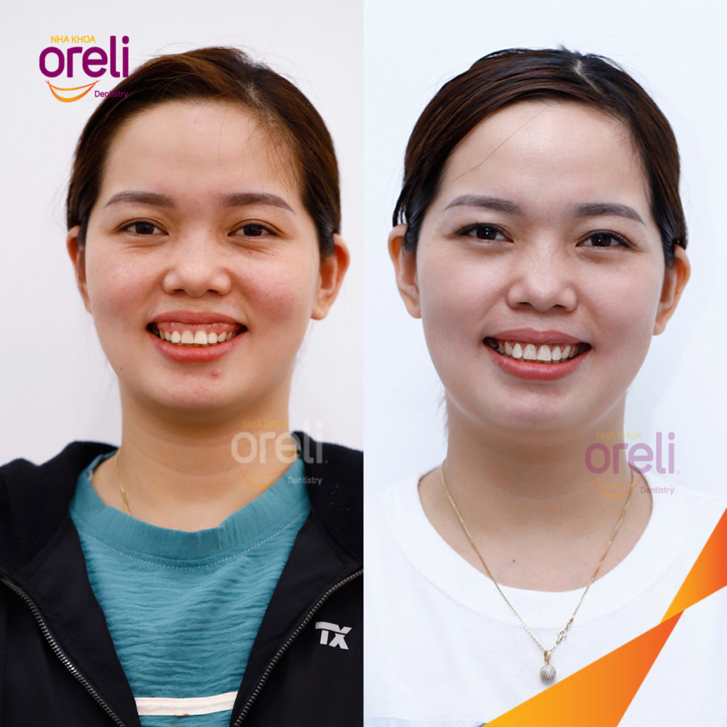 cuoi ho loi nha khoa oreli