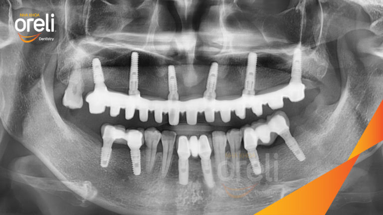 Case Implant hàm trên – Khôi phục răng mất, cải thiện thẩm mỹ | Oreli