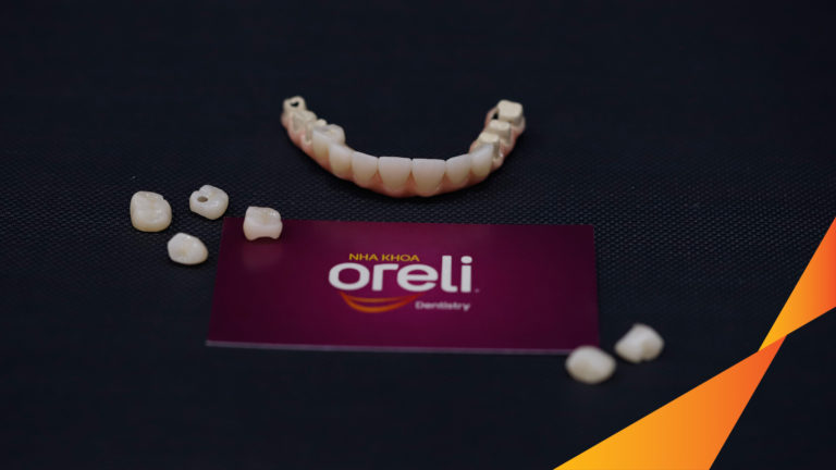 Case Implant hàm trên – Khôi phục răng mất, cải thiện thẩm mỹ | Oreli