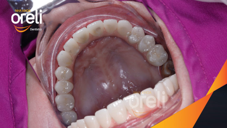 Case Implant hàm trên – Khôi phục răng mất, cải thiện thẩm mỹ | Oreli