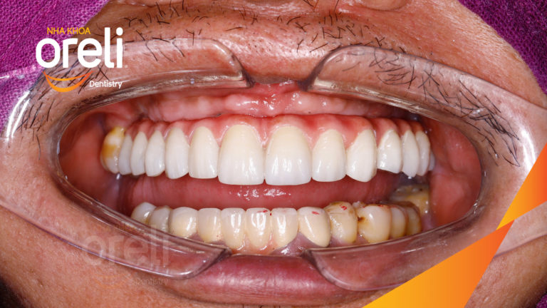 Kết quả trồng răng Implant hàm trên – Khôi phục chức năng ăn nhai | Oreli