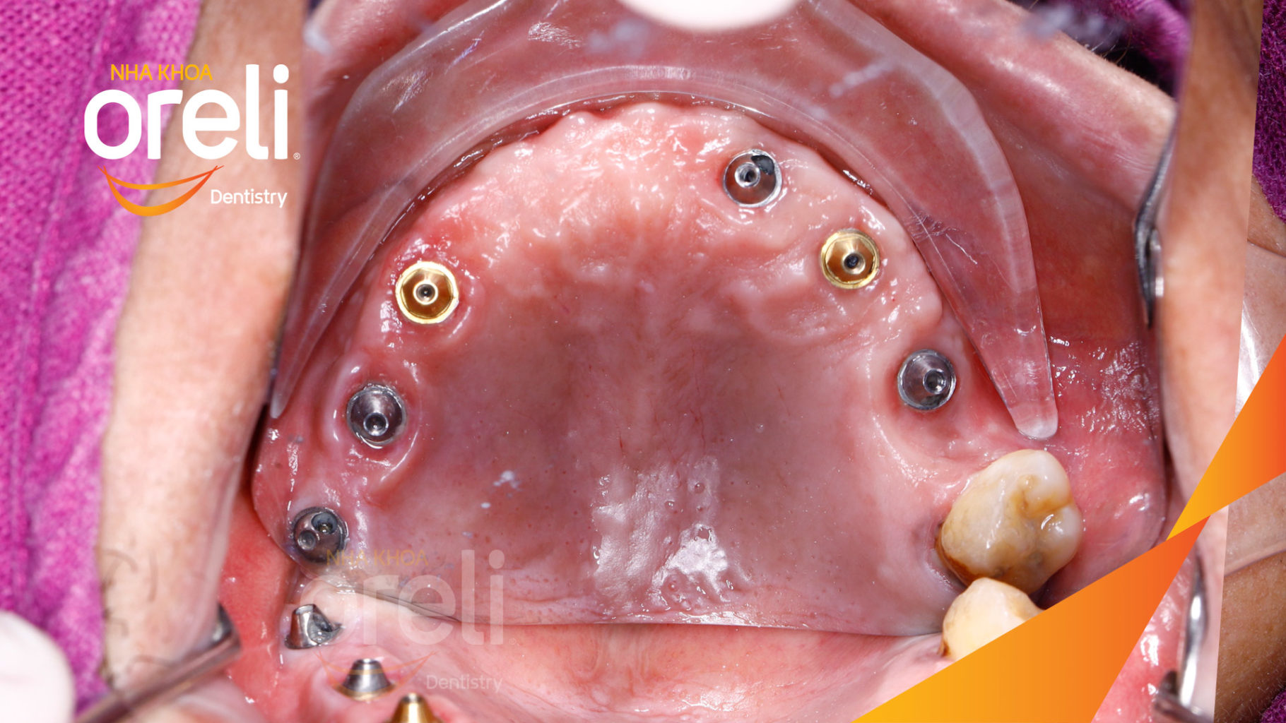 cay ghep implant all on 4 hàm tren oreli