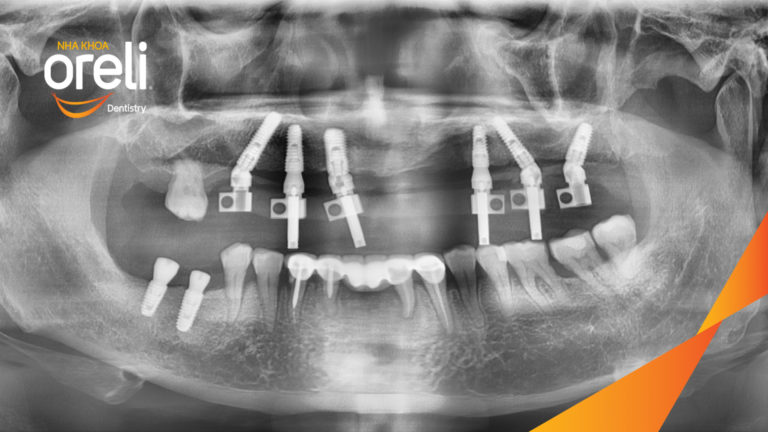 Kết quả trồng răng Implant hàm trên – Khôi phục chức năng ăn nhai | Oreli