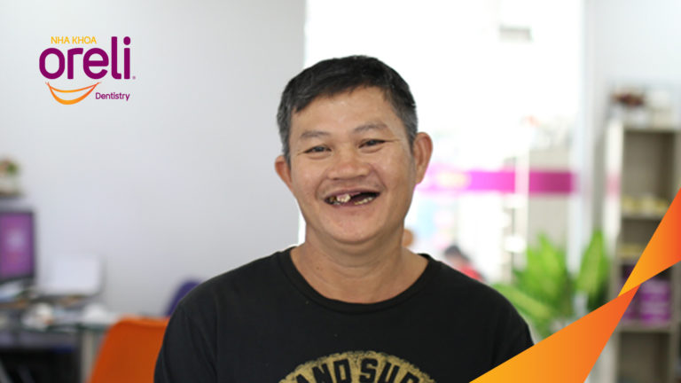 Kết quả trồng răng Implant hàm trên – Khôi phục chức năng ăn nhai | Oreli