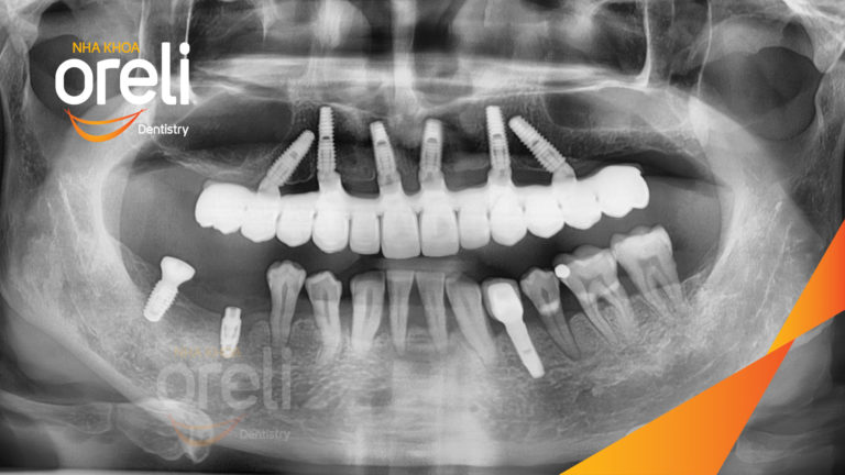 Ca trồng răng hàm trên – Khôi phục ăn nhai vững vàng | Oreli