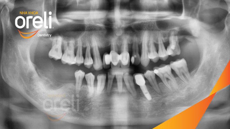 Ca trồng răng hàm trên – Khôi phục ăn nhai vững vàng | Oreli