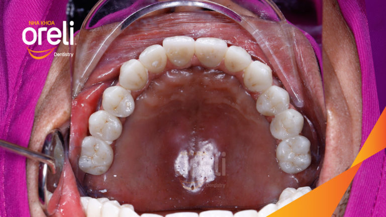 Ca trồng răng hàm trên – Khôi phục ăn nhai vững vàng | Oreli