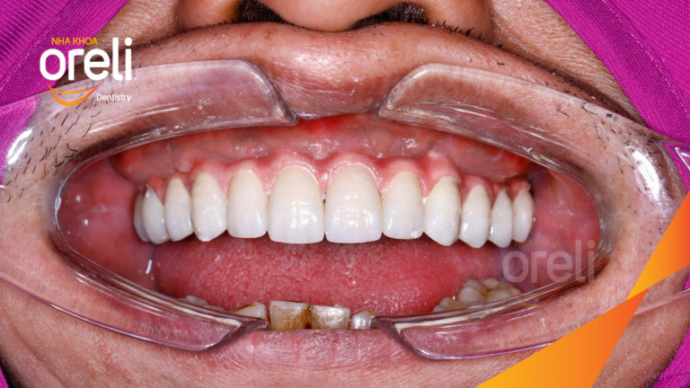 Ca trồng răng hàm trên – Khôi phục ăn nhai vững vàng | Oreli