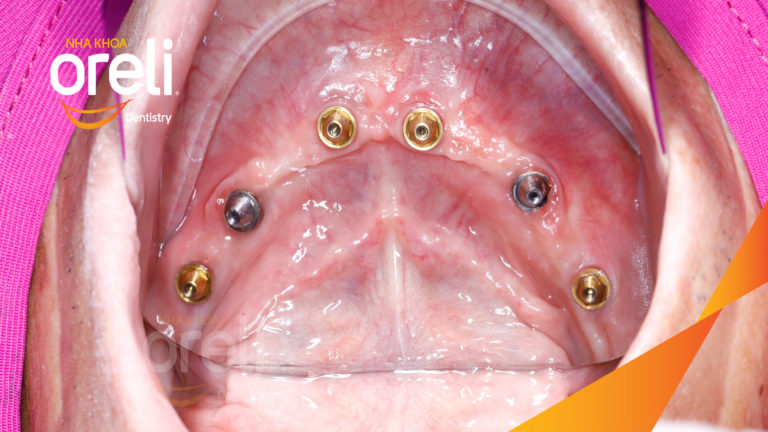 Ca trồng răng Implant hàm dưới – Mất răng lâu năm được phục hồi | Oreli