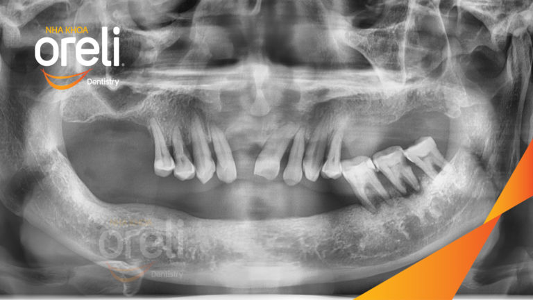 Ca trồng răng Implant hàm dưới – Mất răng lâu năm được phục hồi | Oreli