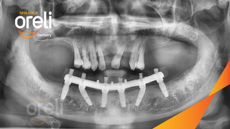 Ca trồng răng Implant hàm dưới – Mất răng lâu năm được phục hồi | Oreli
