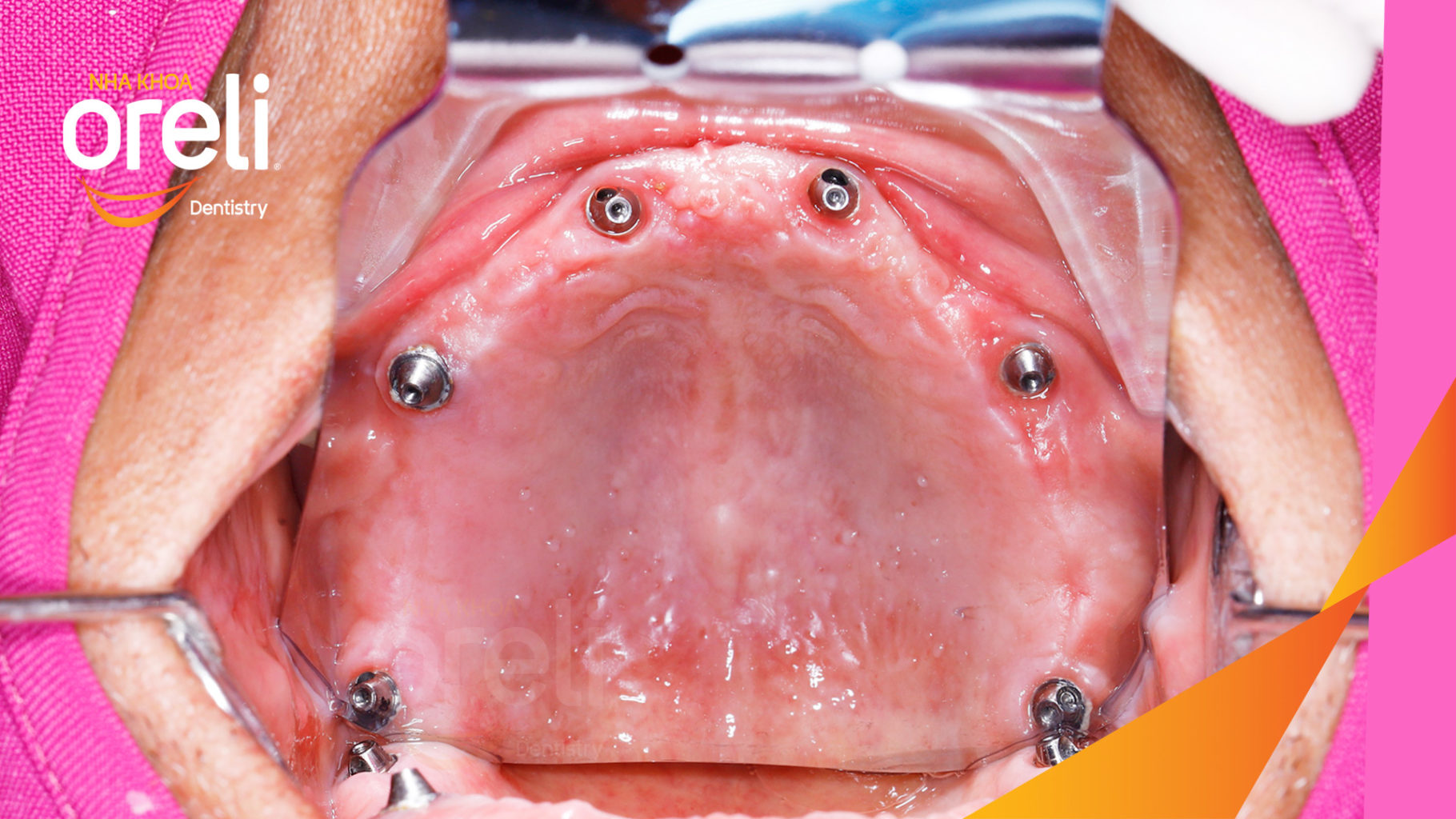 cay ghep implant uy tin buon ma thuot
