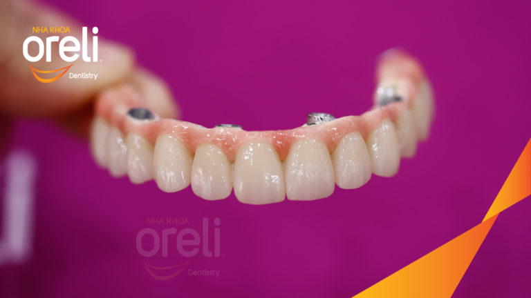 Trồng răng Implant hàm trên – Ăn nhai chắc chắn, nụ cười tự nhiên | Oreli