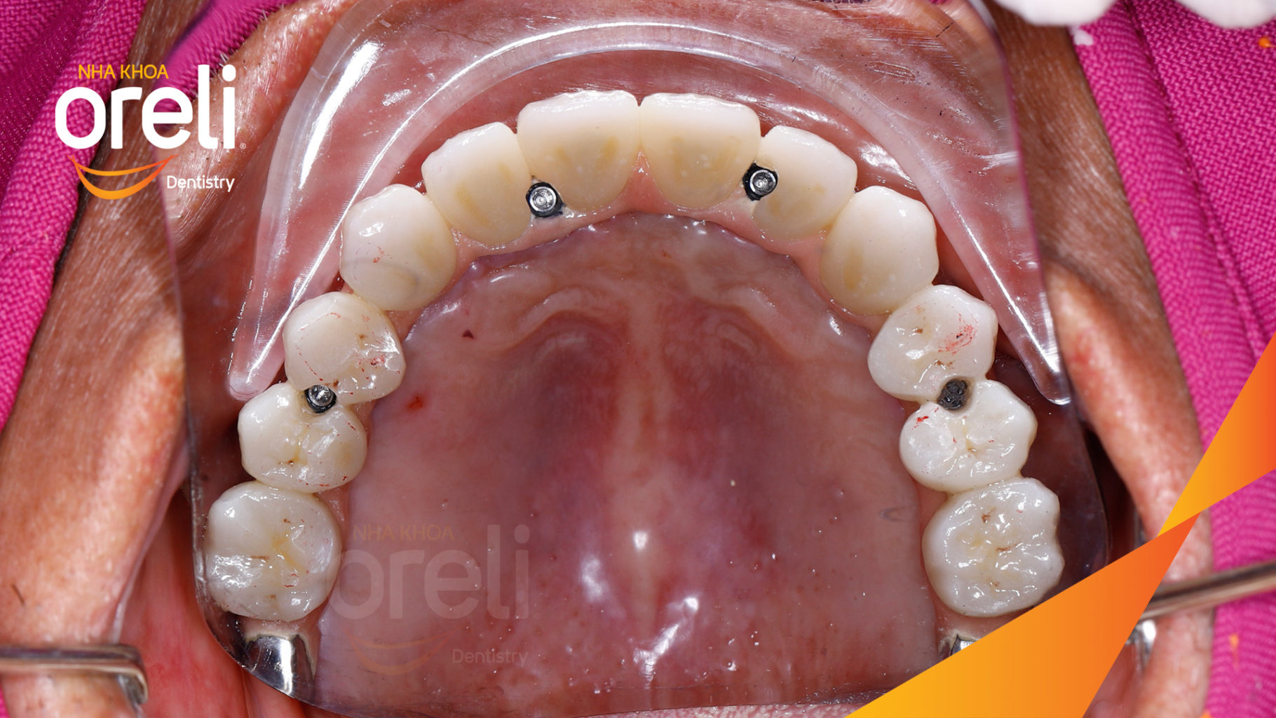 cay ghep implant uy tin buon ma thuot