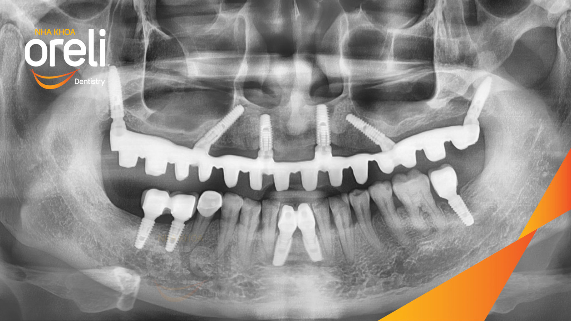 cay ghep implant uy tin buon ma thuot