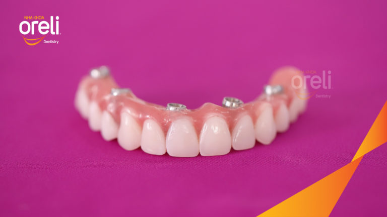 Case Implant hàm trên – Khôi phục răng mất, cải thiện thẩm mỹ | Oreli