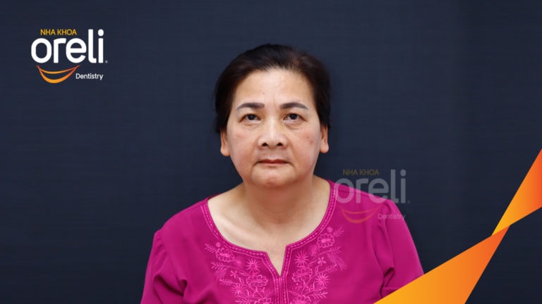 Trồng răng hàm trên và hàm dưới bằng Implant | Kết quả thực tế tại Oreli