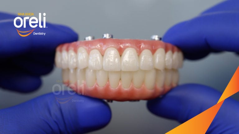 Trồng răng hàm trên và hàm dưới bằng Implant | Kết quả thực tế tại Oreli