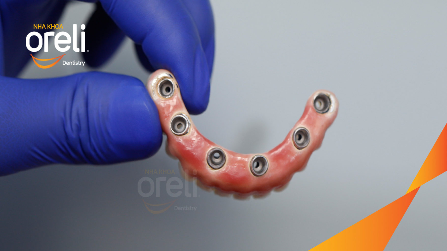 cay ghep implant toan ham oreli