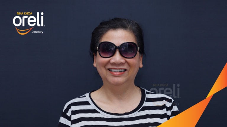 Trồng răng hàm trên và hàm dưới bằng Implant | Kết quả thực tế tại Oreli