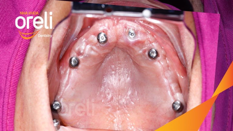 Trồng răng hàm trên và hàm dưới bằng Implant | Kết quả thực tế tại Oreli