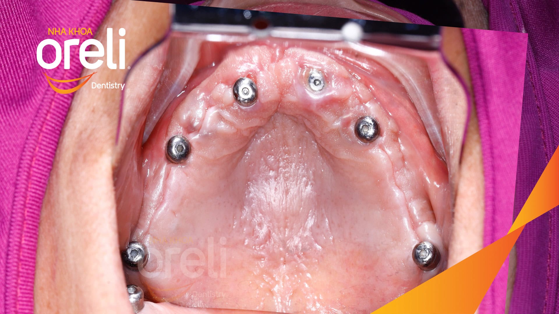cay ghep implant all on 4 hàm tren oreli