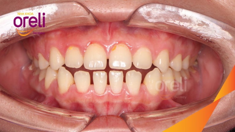 Chỉnh khe thưa răng cửa hai hàm – Kết quả sau 18 tháng tại Nha Khoa Oreli