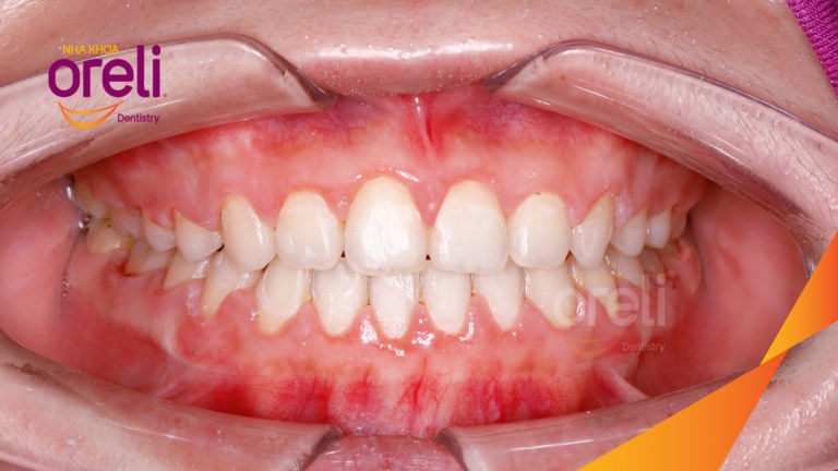 Chỉnh khe thưa răng cửa hai hàm – Kết quả sau 18 tháng tại Nha Khoa Oreli