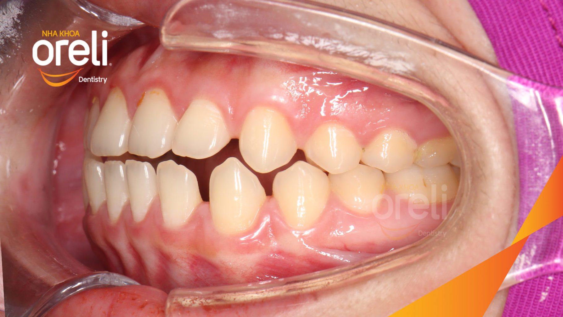 Quá trình  trong  tại Oreli