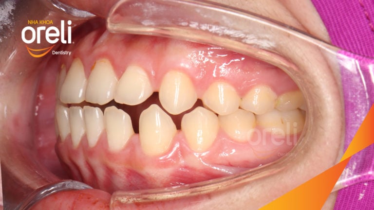 Chỉnh khe thưa răng cửa hai hàm – Kết quả sau 18 tháng tại Nha Khoa Oreli