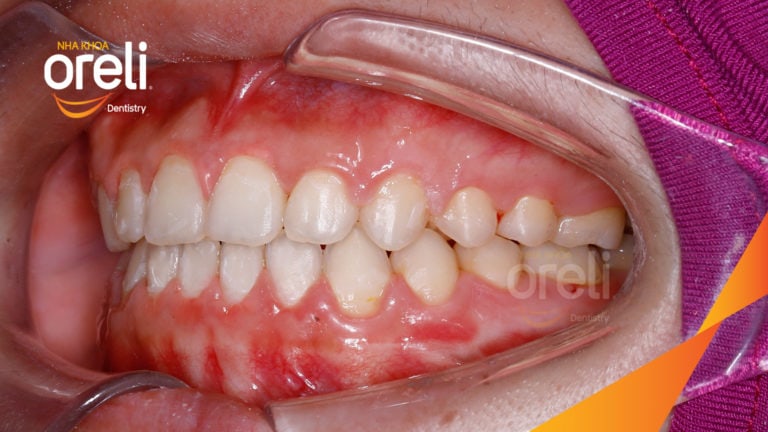 Chỉnh khe thưa răng cửa hai hàm – Kết quả sau 18 tháng tại Nha Khoa Oreli