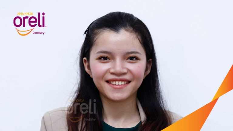 Chỉnh khe thưa răng cửa hai hàm – Kết quả sau 18 tháng tại Nha Khoa Oreli