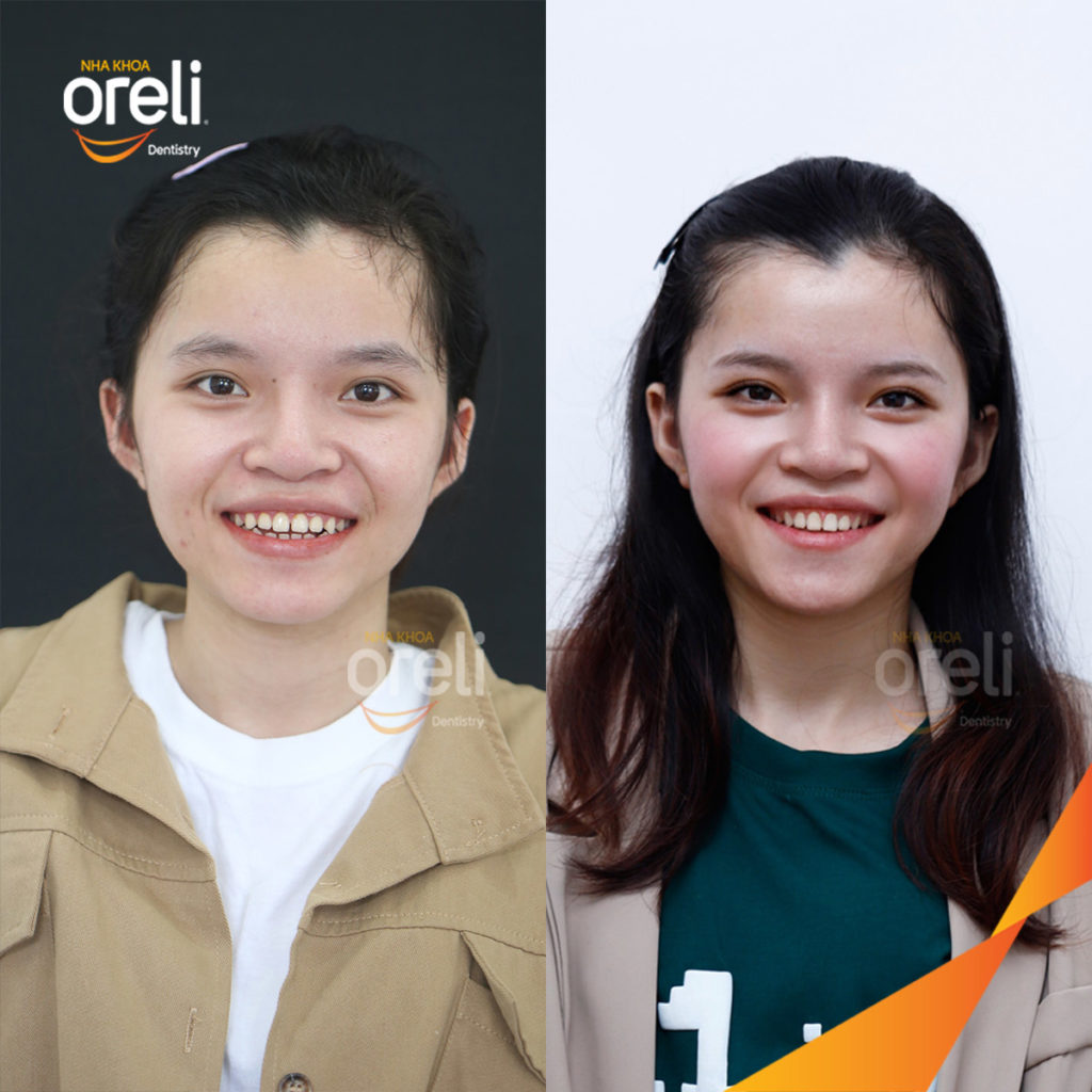 Trước điều trị:  tại Oreli