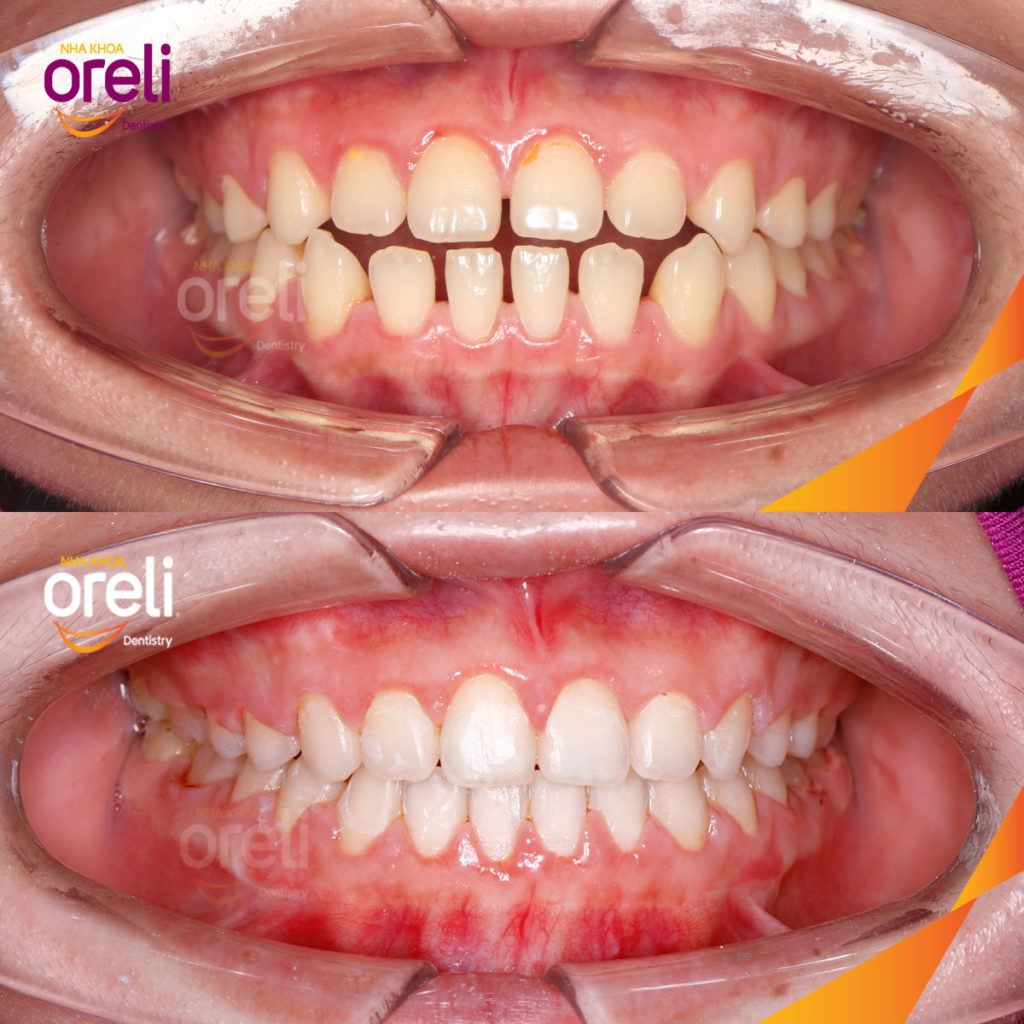 Kết quả đạt được sau  -  tại Oreli