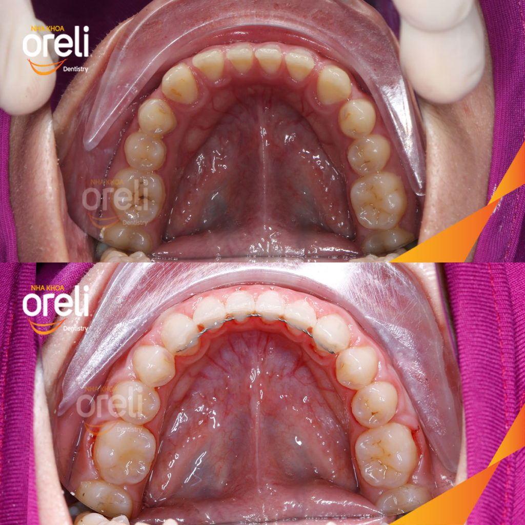 Kết quả sau :  tại Oreli