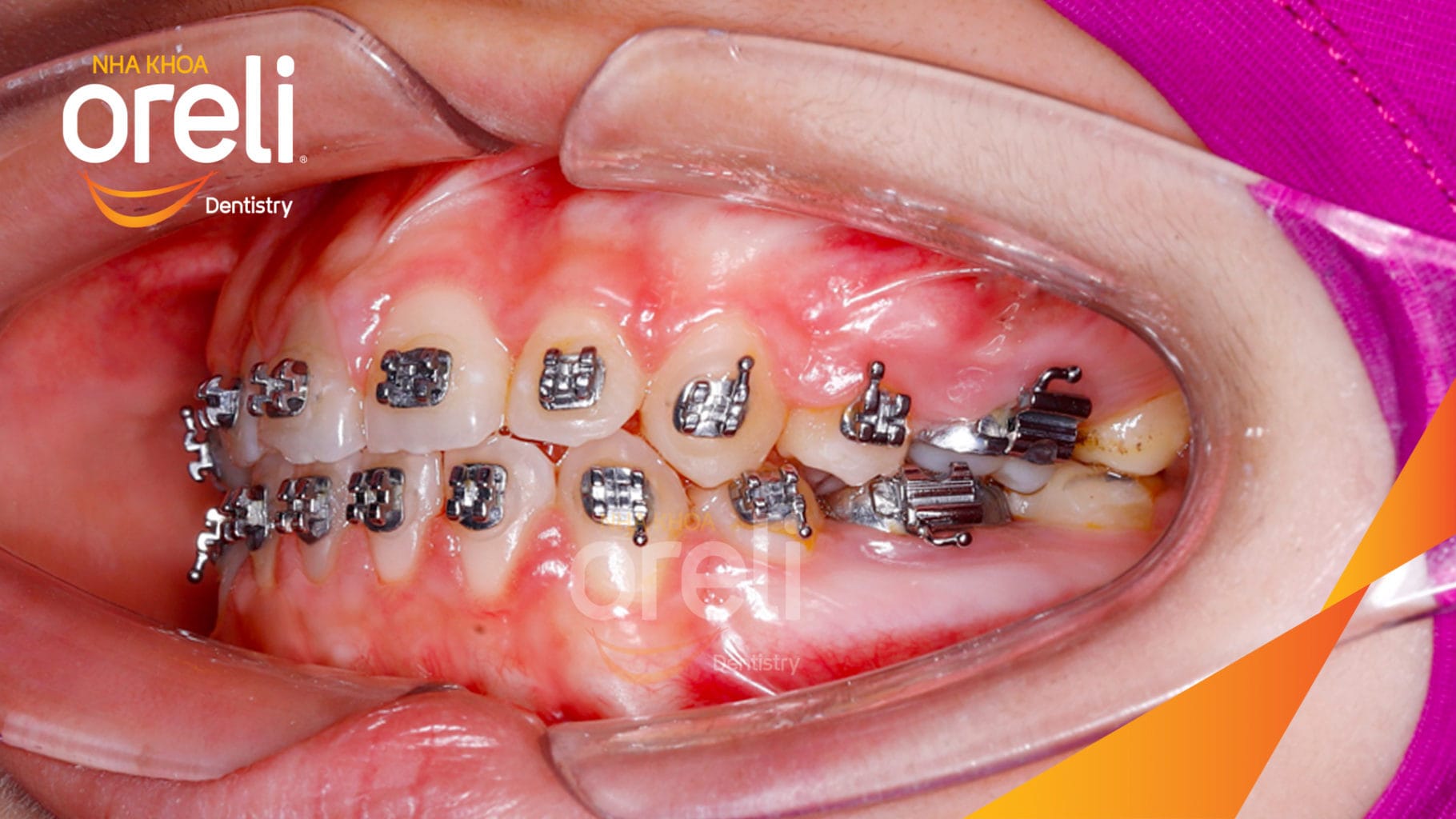 Ca niềng chỉnh hô có nhổ 4 răng 4 cho kết quả đẹp tại Oreli