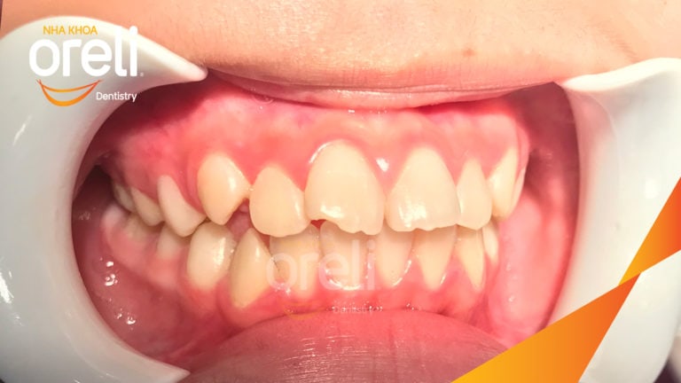 Ca niềng chỉnh hô có nhổ 4 răng 4 cho kết quả đẹp tại Oreli