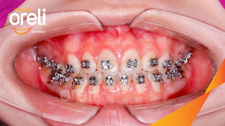 nieng rang ho uy tin bmt daklak nha khoa oreli