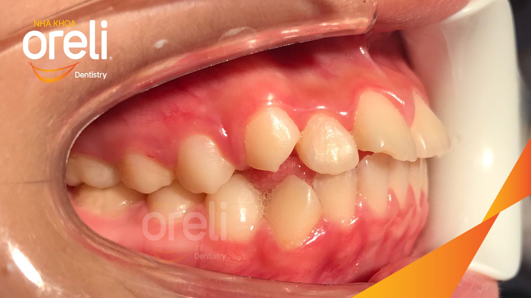 Ca niềng chỉnh hô có nhổ 4 răng 4 cho kết quả đẹp tại Oreli