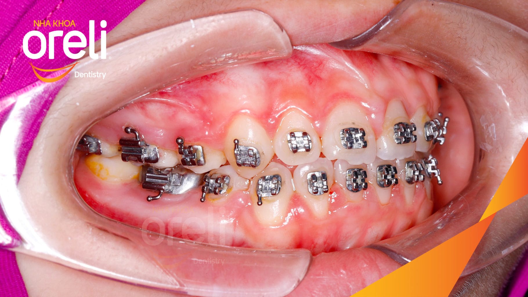 Ca niềng chỉnh hô có nhổ 4 răng 4 cho kết quả đẹp tại Oreli