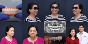 cay ghep implant