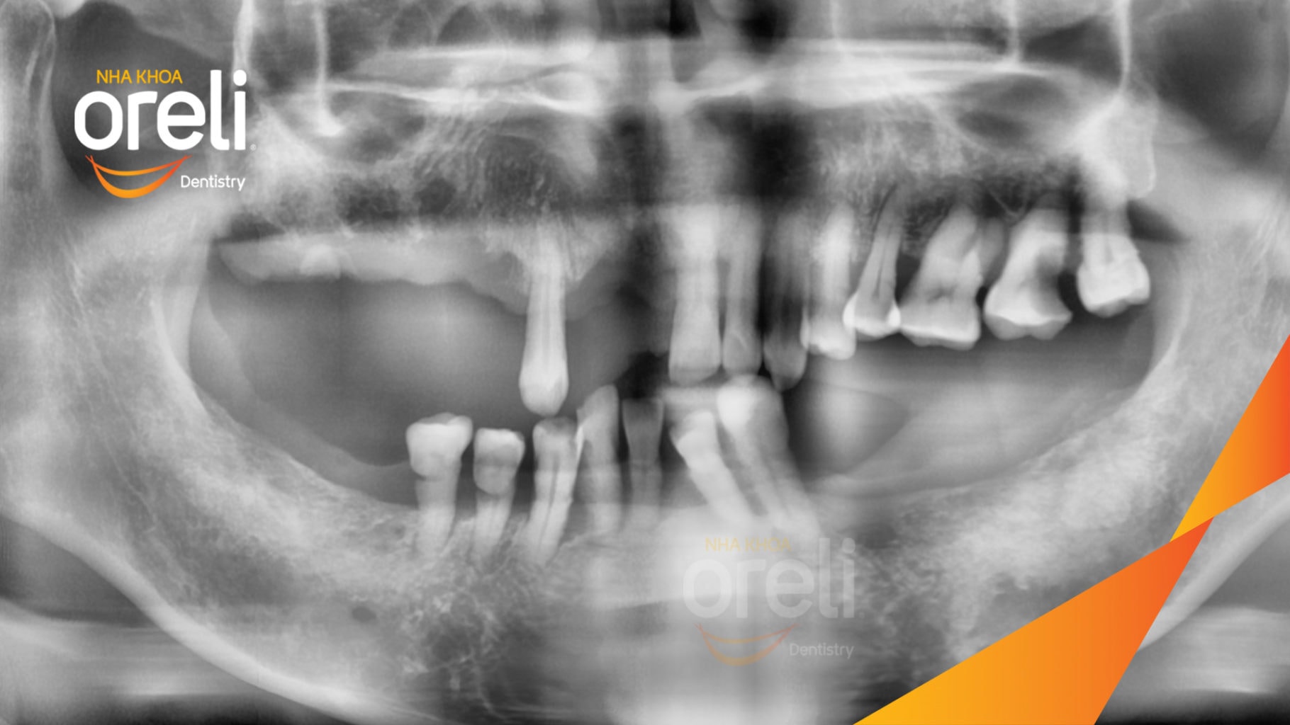Ca trồng răng Implant chỉnh hô hai hàm tại Oreli