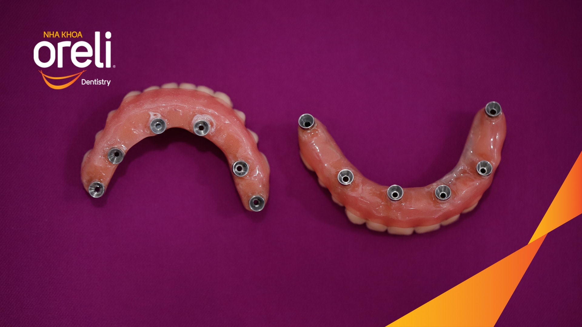 cấy implant uy tín bmt