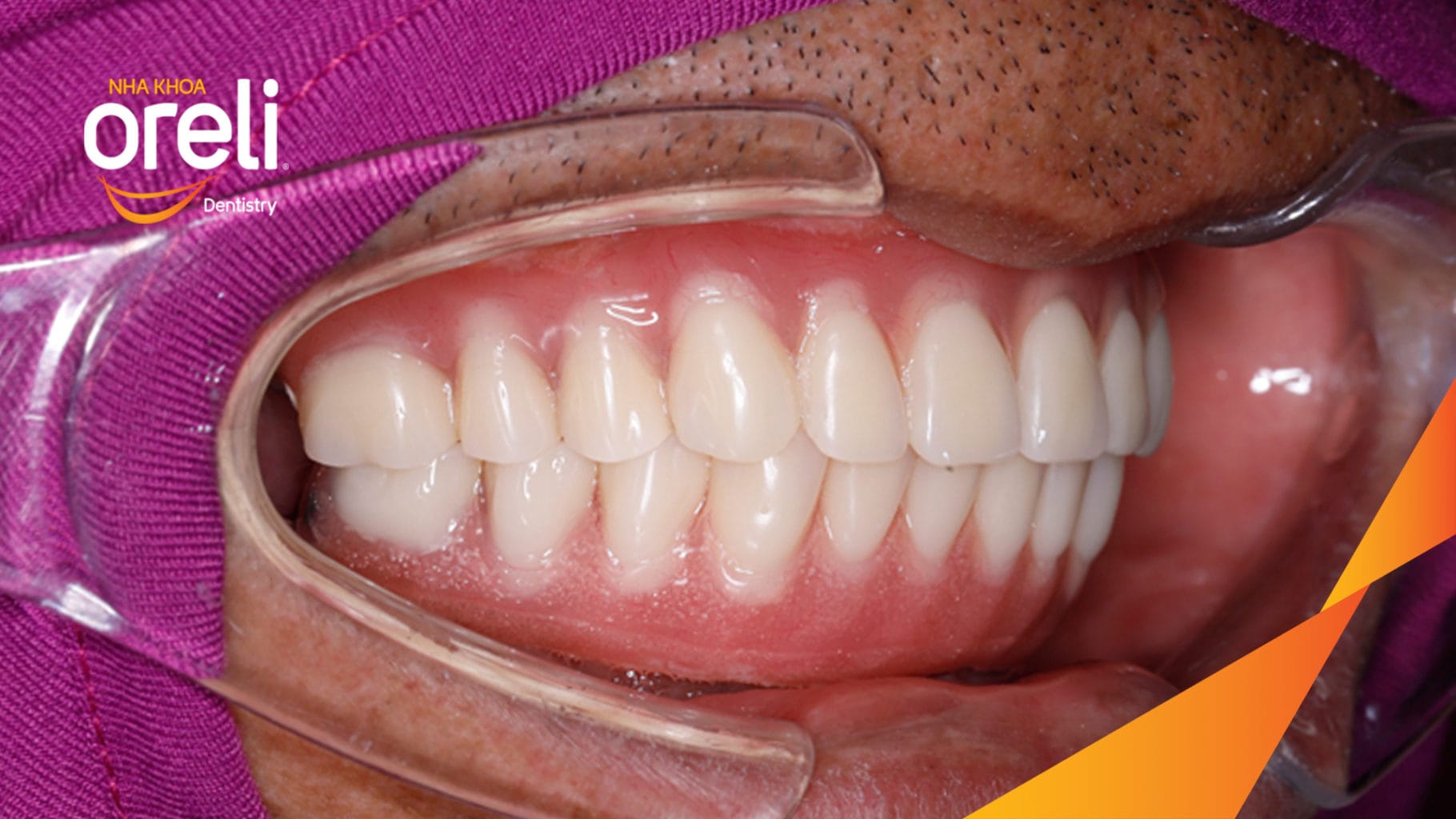 Ca trồng răng Implant chỉnh hô hai hàm tại Oreli