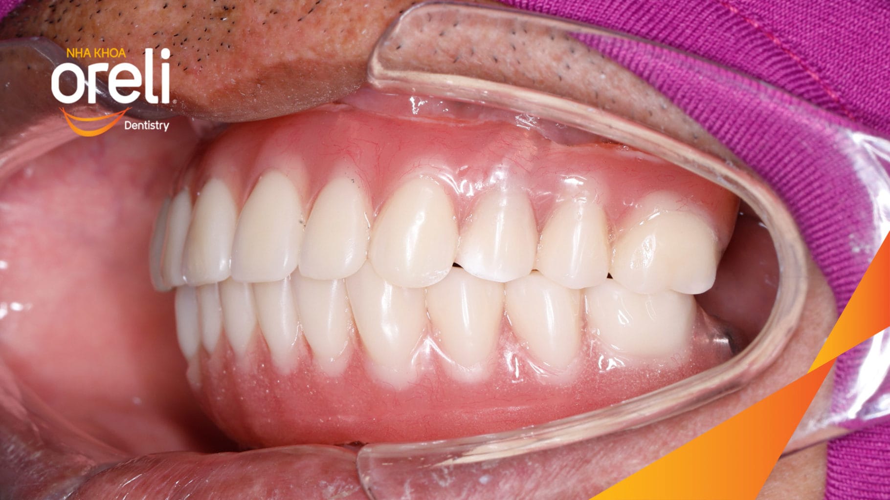 Ca trồng răng Implant chỉnh hô hai hàm tại Oreli